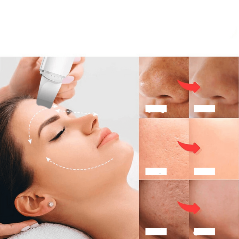 Esfoliador LumiDerma Ultrassônico de Pele: Removedor de Cravos e Limpador Facial com Cavitação